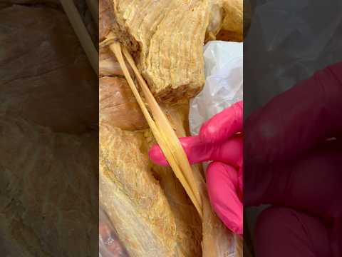 Irritating the Sciatic Nerve