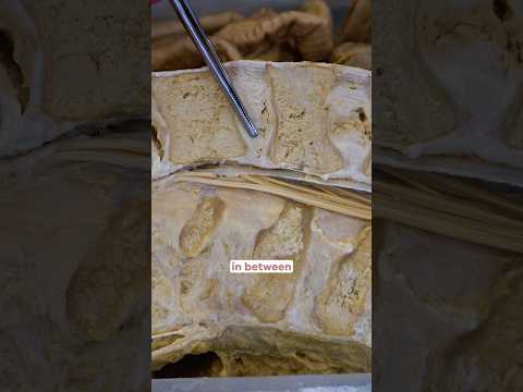 Herniated Discs!