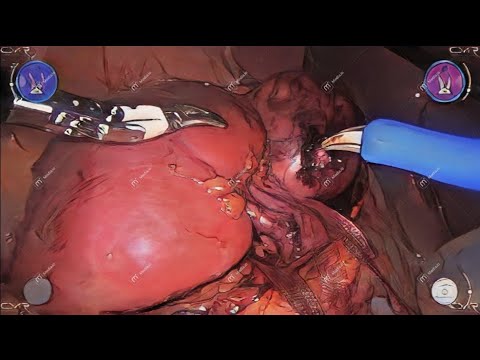 Robot-assisted lap right Partial Nephrectomy  استئصال ورم من الكلية مع الحفاظ على باقي نسيج الكلية