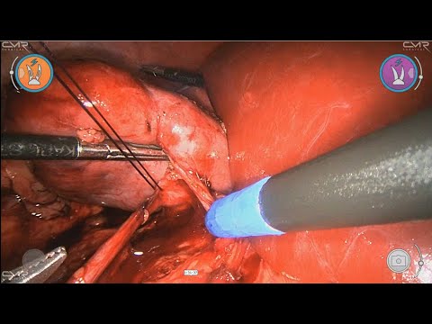 Robot assisted Laparoscopic right pyeloplasty with an intrarenal pelvis