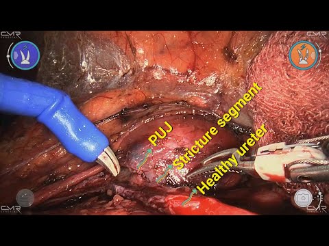 Robot-assisted Laparoscopic Y-V Pyeloplasty for a recurrent long segment PUJ obstruction