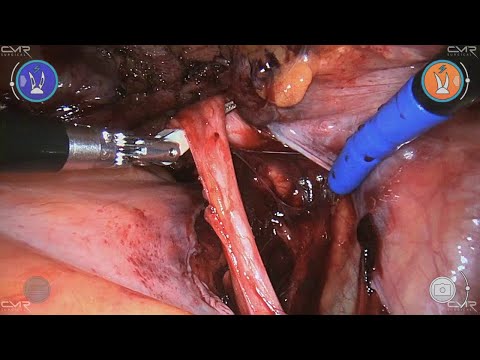 Robot assisted lap. uretero-vesical reimplantation (Direct ureterovesical reimplantation)