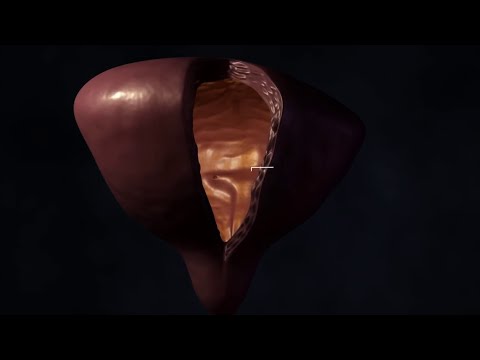 Bladder Cancer أورام المثانة البولية (أسباب وأعراض و تشخيص و علاج سرطان / ورم المثانة البولية)